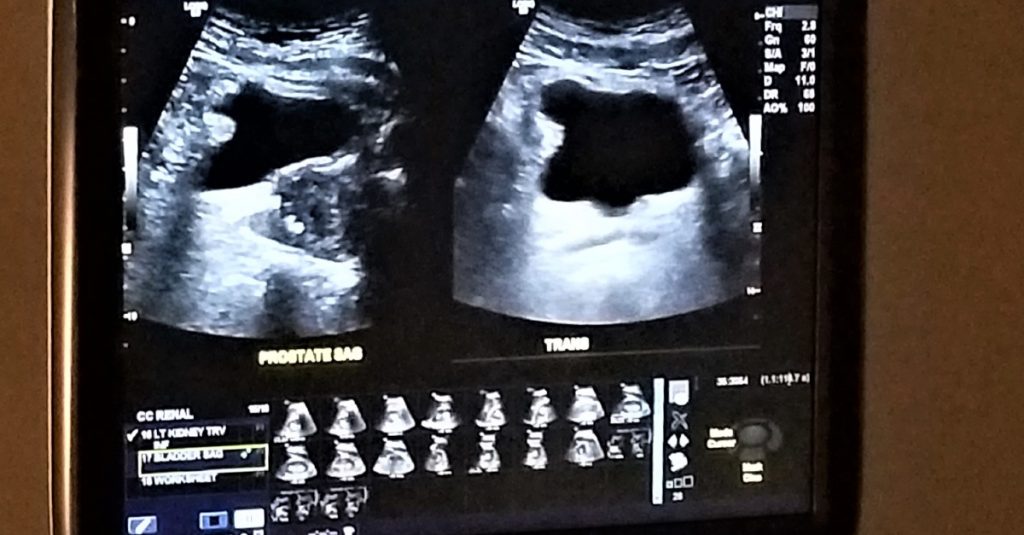ultrazvuk prostaty 