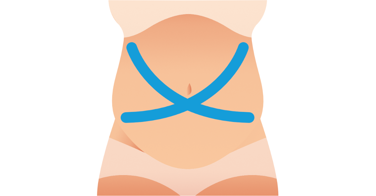 Kinesio pásky počas tehotenstva