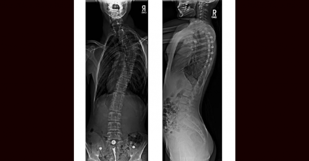 röntgen chrbtice ortopedickým digitálnym panelom