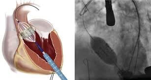Katétrová implantácia aortálnej chlopne