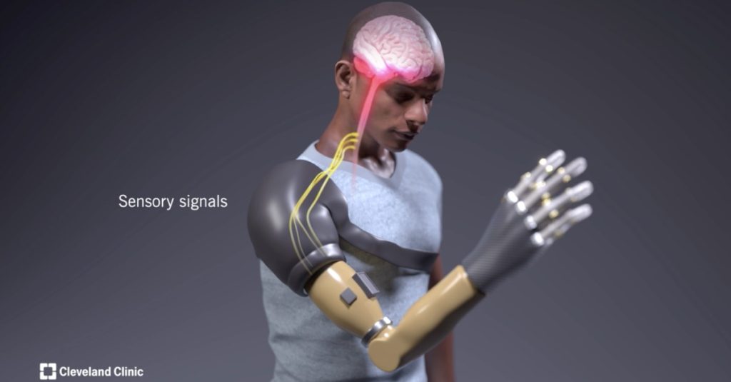 Bionická ruka, ktorá dokáže navrátiť pacientom s amputovanou hornou končatinou prirodzený pohyb