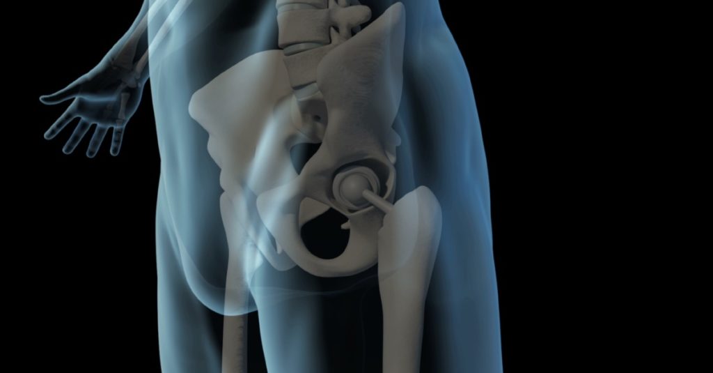 Bioaktívne nátery pre lepšie ortopedické implantáty